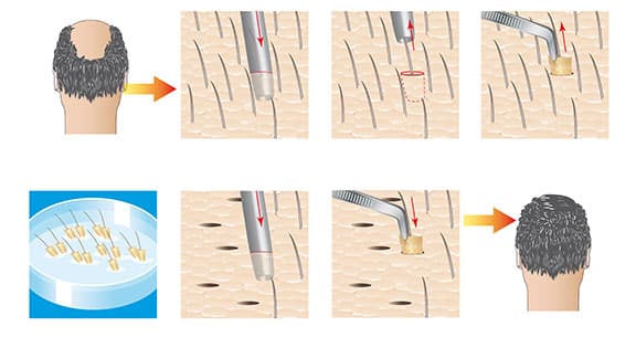 Hair Transplant Surgery
