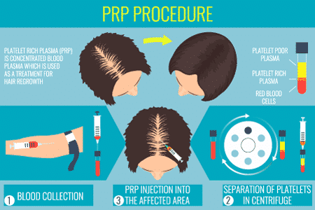 PRP para la caída del cabello