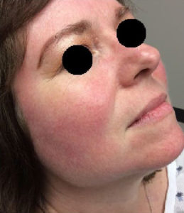 Rosacea Treatment Before and After Pictures