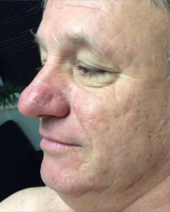 Rosacea Treatment Before and After Pictures