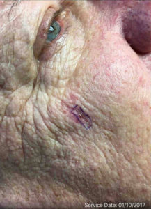 Skin Cancer Treatment Before and After Pictures
