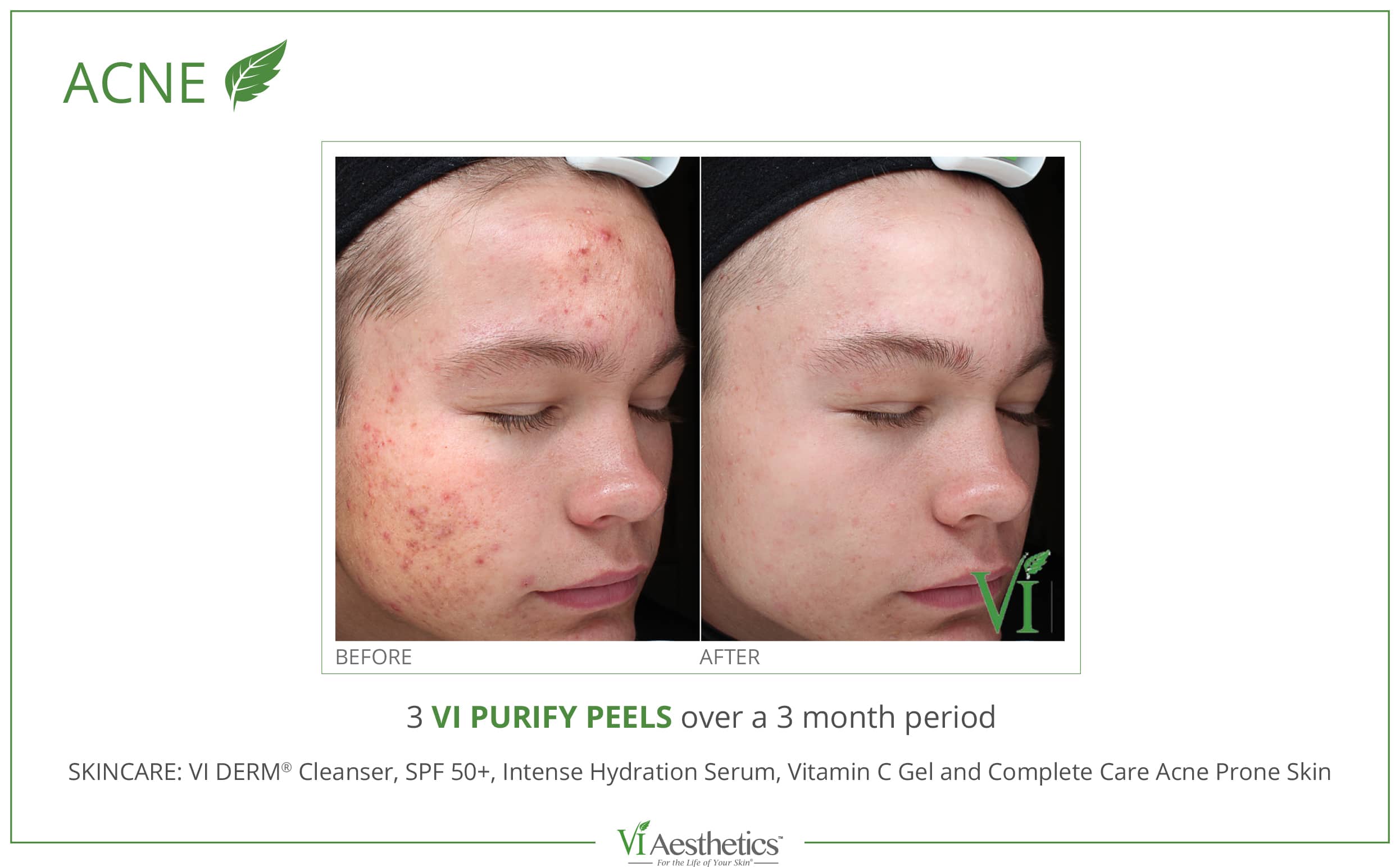 Acne Treatment Near Me