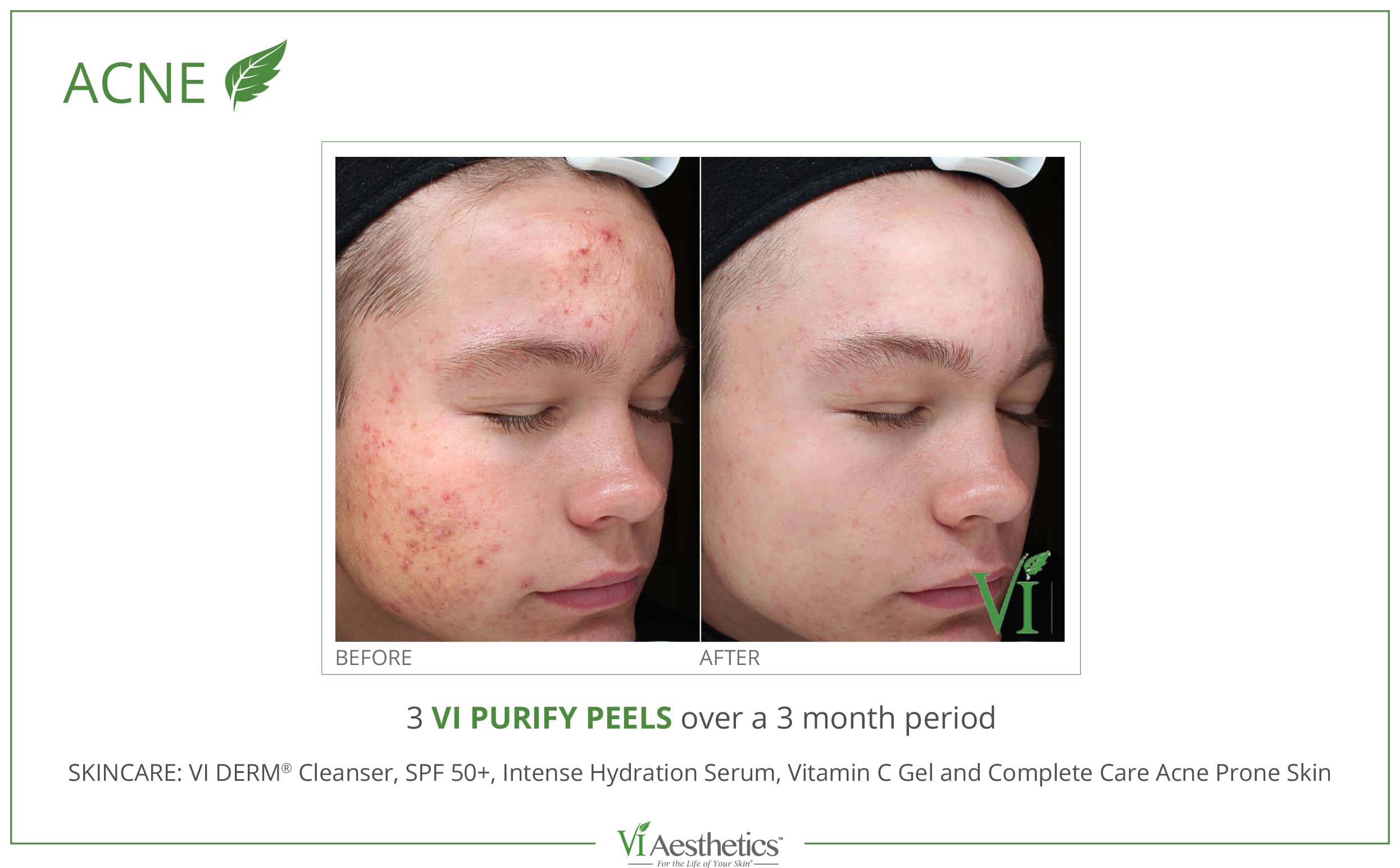 Acne Treatment in Roswell, GA