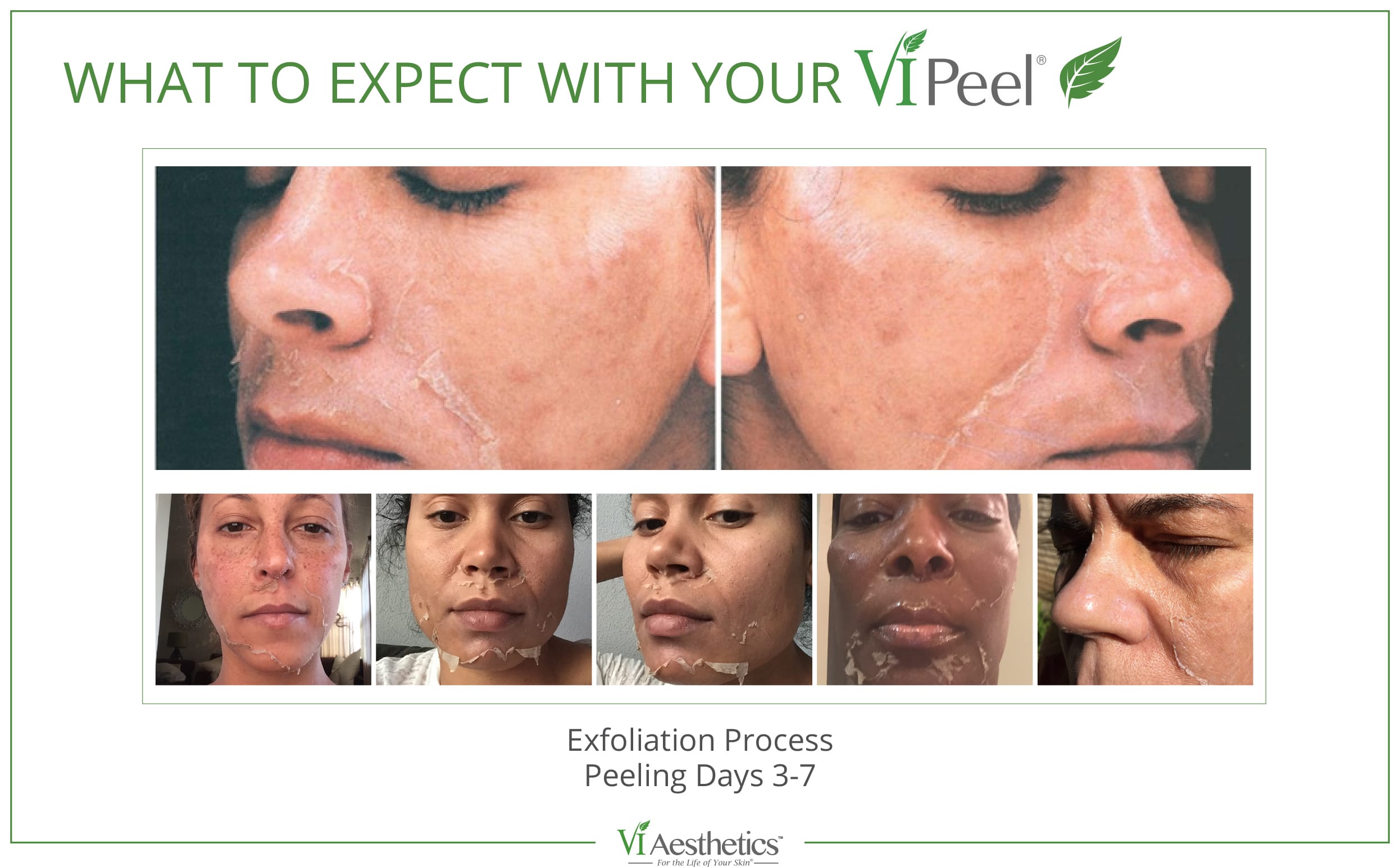 Chemical Peels in Roswell, GA