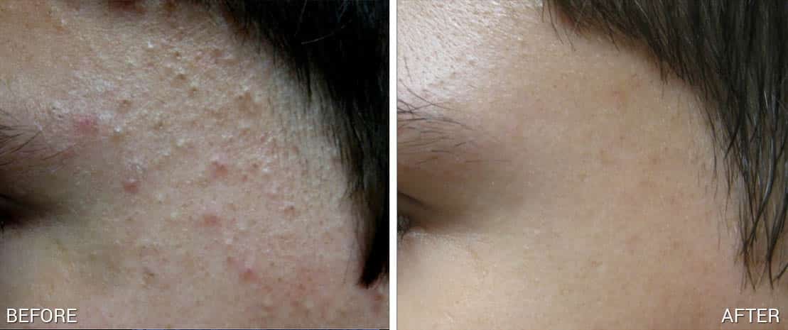 After 3 treatments, Suneel Chilukuri MD