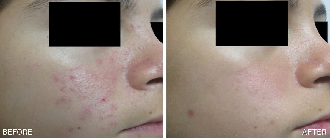 After 1 treatment, Suneel Chilukuri MD