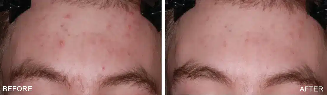 Before and After Photo TheraClearX