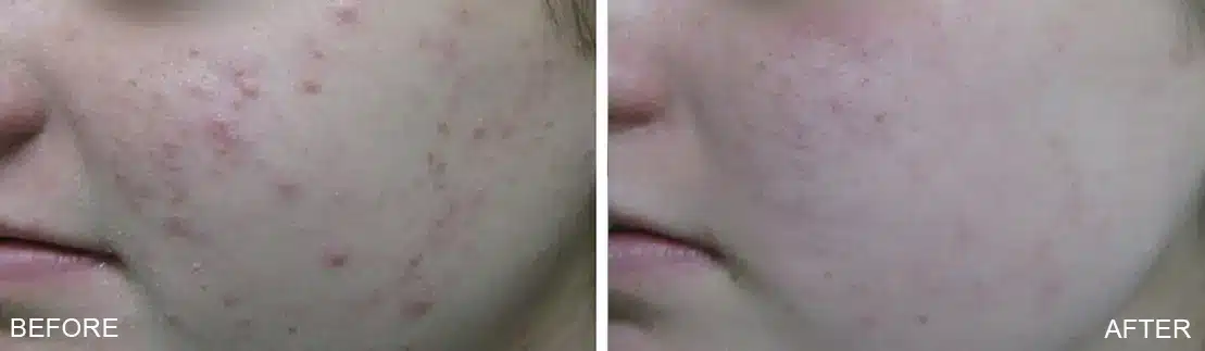Before and After Photo TheraClearX