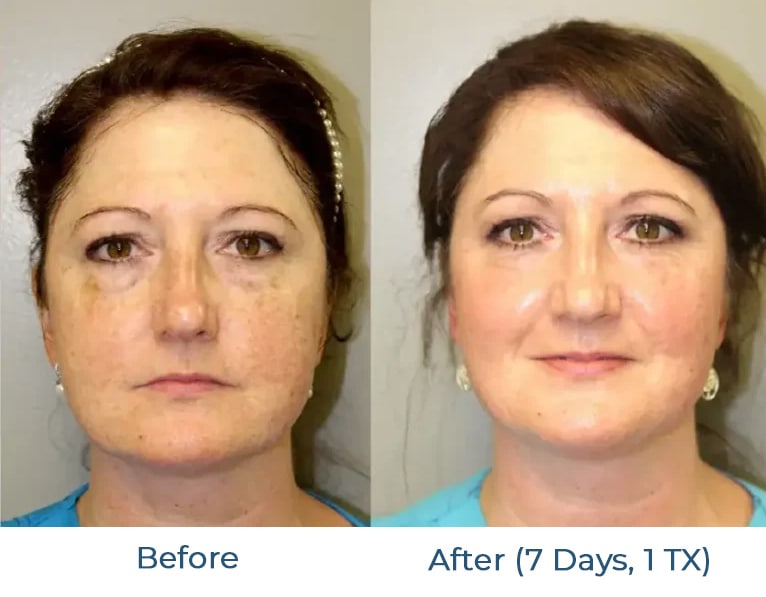 Antes y después del tratamiento CoolPeel Foto 3