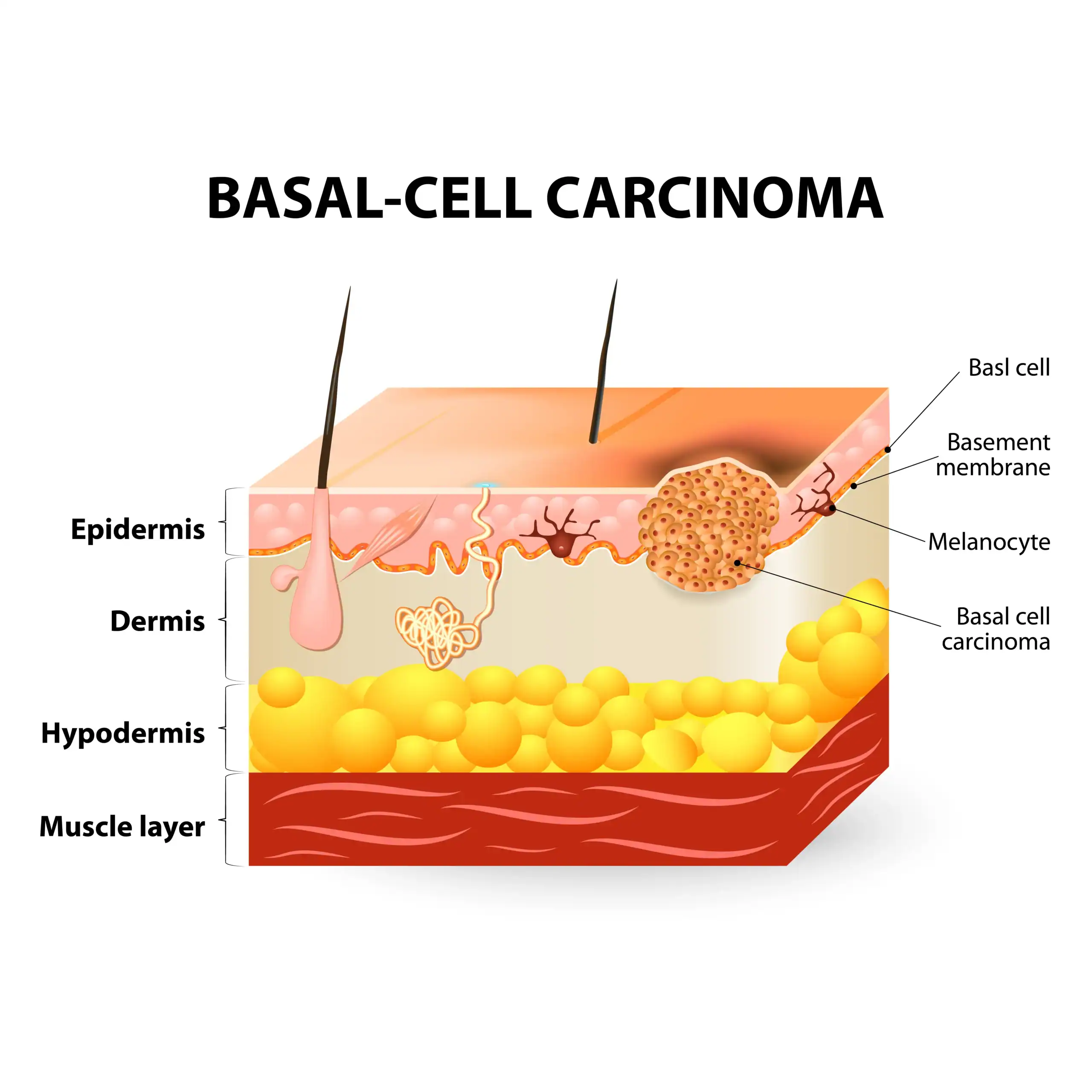 Graphic explaining where basal cell carcinoma affects the skin