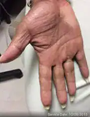 Subject 1, shown after treatment for eczema at Goodman Dermatology