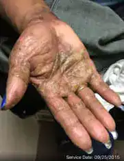 Subject 1, shown before treatment for eczema at Goodman Dermatology