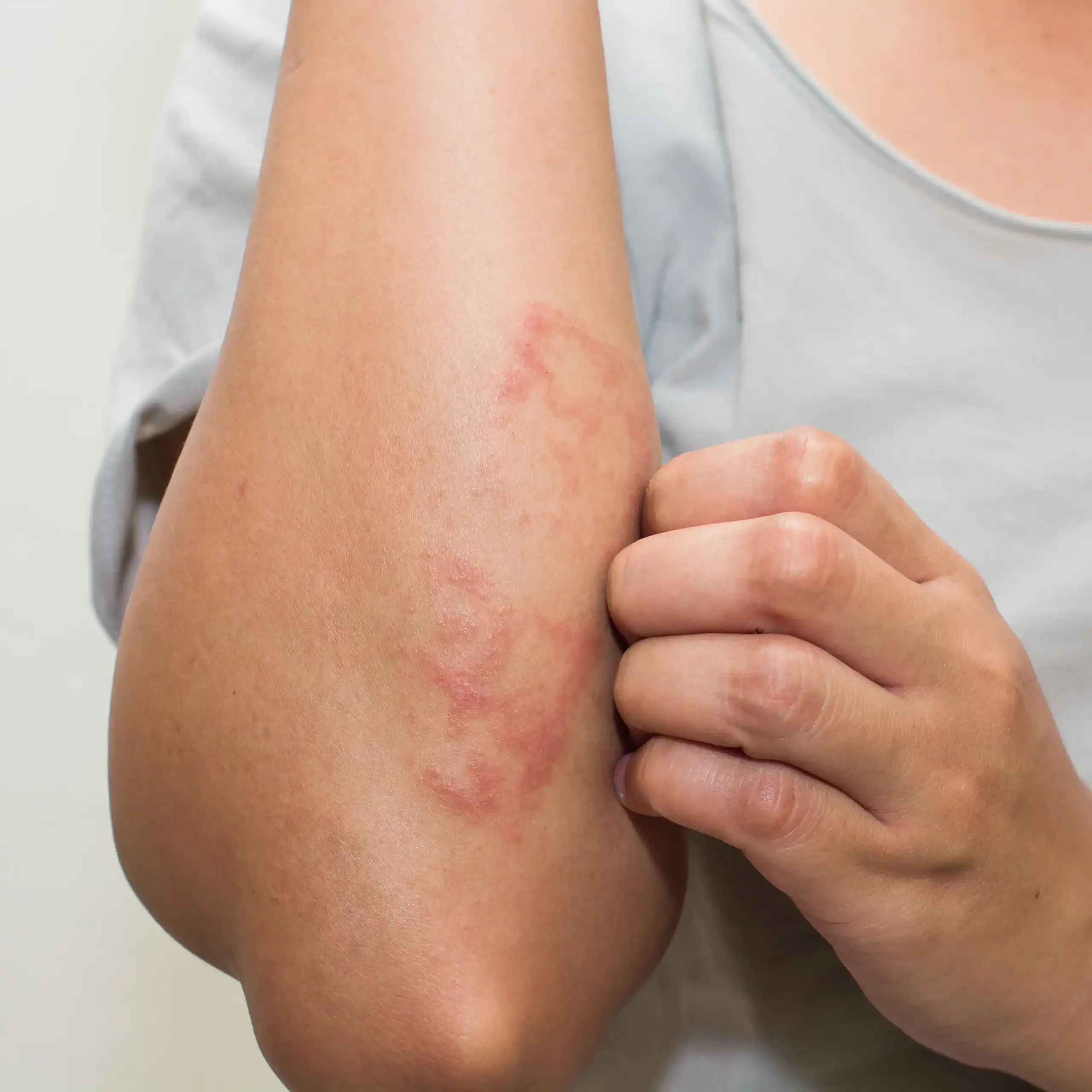 Woman with eczema rash on her lower arm