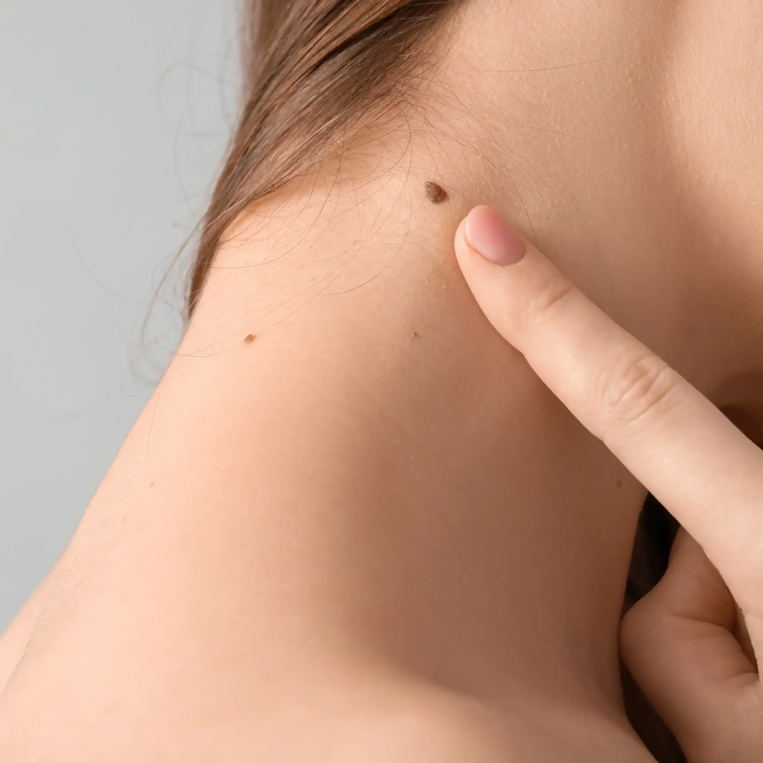 A woman points to a mole on her neck near her hairline