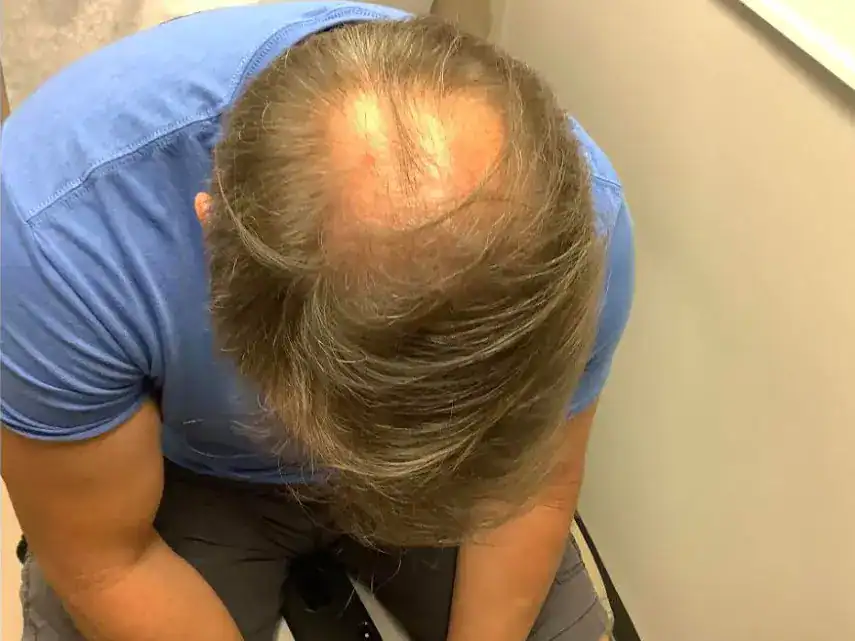 Subject 1 shown after PRP hair treatments