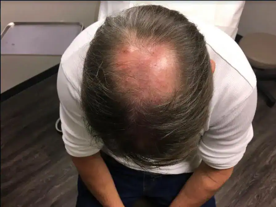 Subject 1 shown before PRP hair treatments