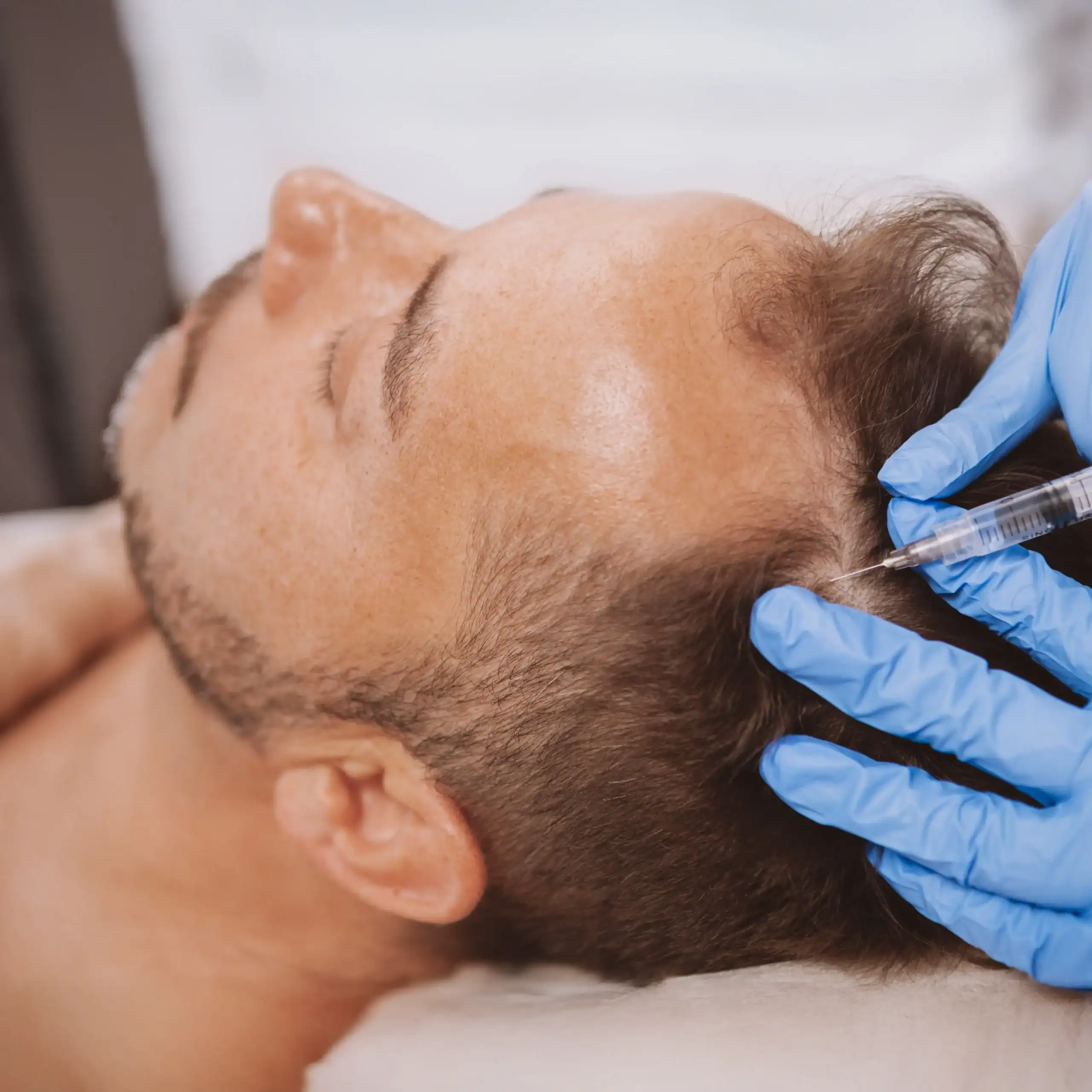 Man gets PRP injection in his scalp to help regrow hair