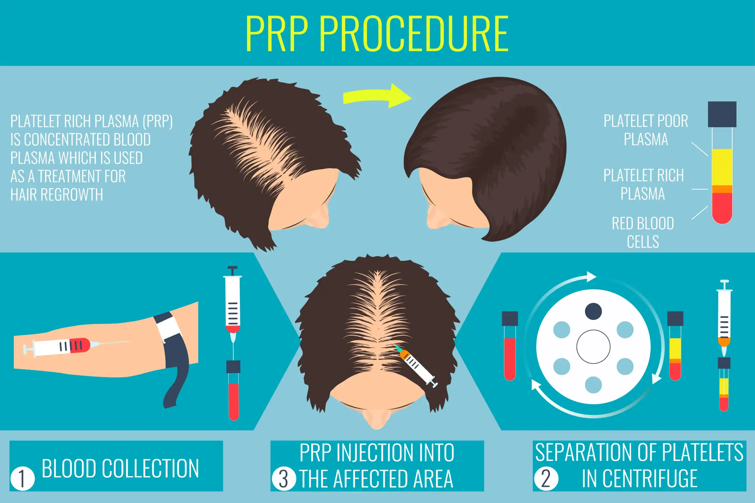 Graphic explaining how PRP for hair growth works
