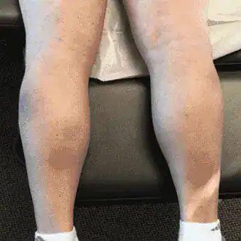 Subject 1, showing back of the legs after treatment for psoriasis at Goodman Dermatology