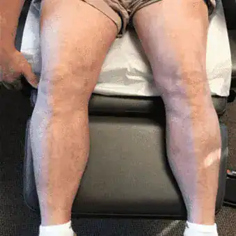 Subject 1, showing front of the legs after treatment for psoriasis at Goodman Dermatology