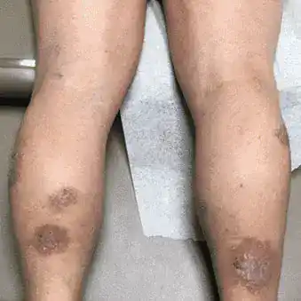 Subject 1, showing back of the legs before treatment for psoriasis at Goodman Dermatology