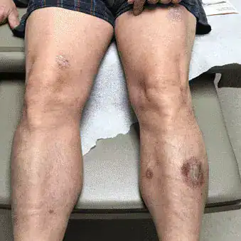 Subject 1, showing front of the legs before treatment for psoriasis at Goodman Dermatology