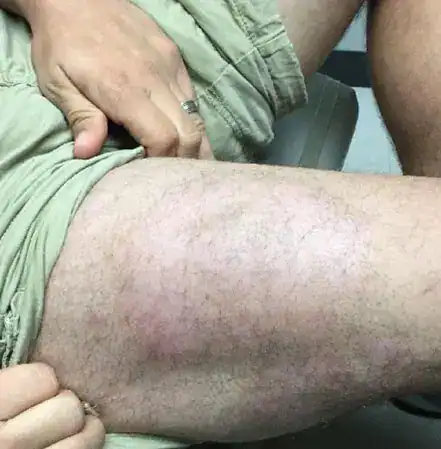 Subject 2, showing thigh after treatment for psoriasis at Goodman Dermatology