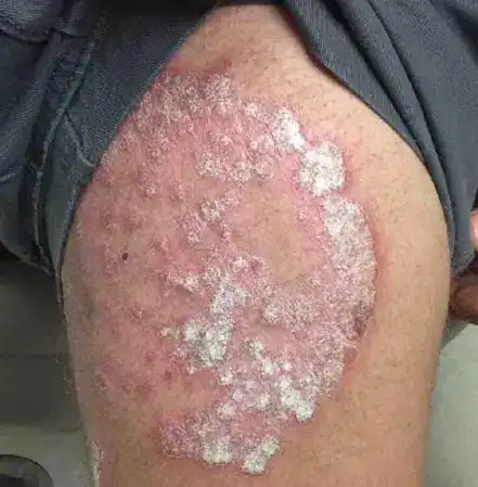 Subject 2, showing thigh before treatment for psoriasis at Goodman Dermatology