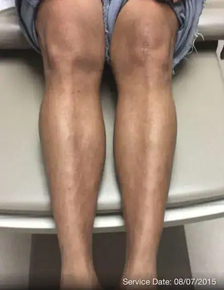 Subject 3, showing legs after treatment for psoriasis at Goodman Dermatology