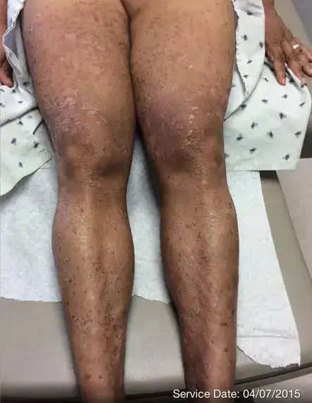 Subject 3, showing legs before treatment for psoriasis at Goodman Dermatology