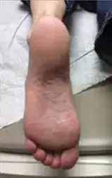 Subject 4, showing foot after treatment for psoriasis at Goodman Dermatology