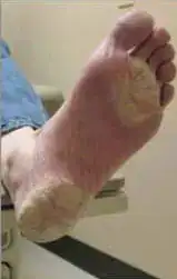 Subject 4, showing foot before treatment for psoriasis at Goodman Dermatology