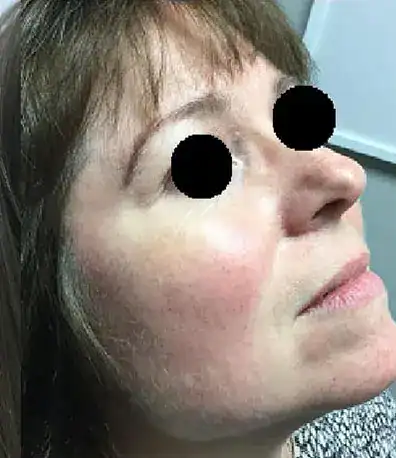 Subject 1, shown after treatment for rosacea at Goodman Dermatology