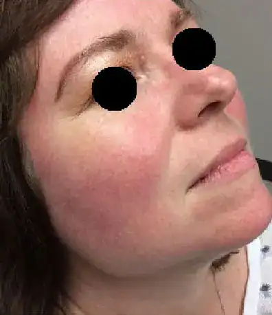 Subject 1, shown before treatment for rosacea at Goodman Dermatology