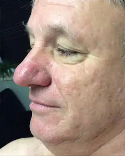 Subject 2, shown after treatment for rosacea at Goodman Dermatology