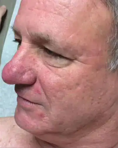 Subject 2, shown before treatment for rosacea at Goodman Dermatology