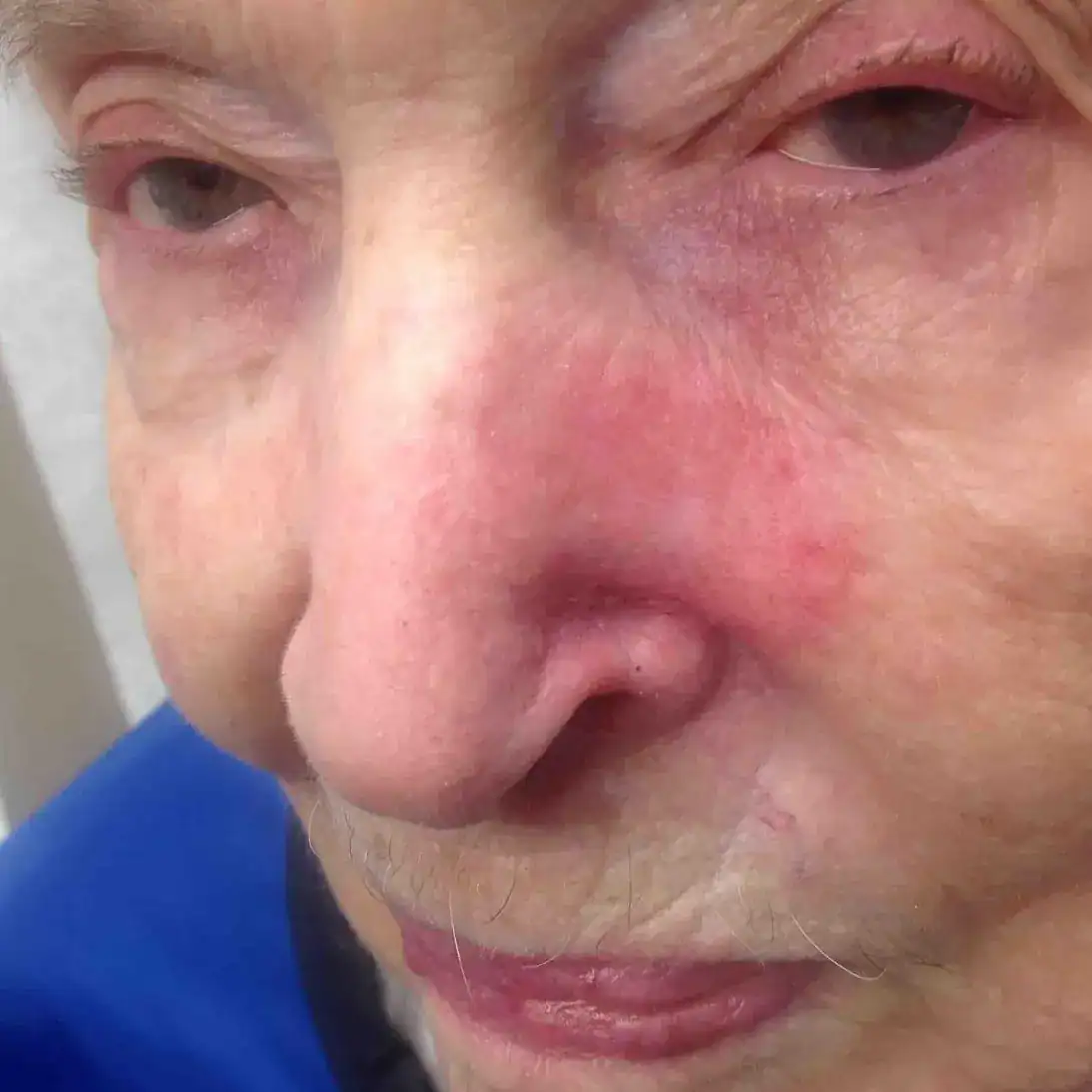 Subject 1, shown after superficial radiotherapy (SRT) at Goodman Dermatology