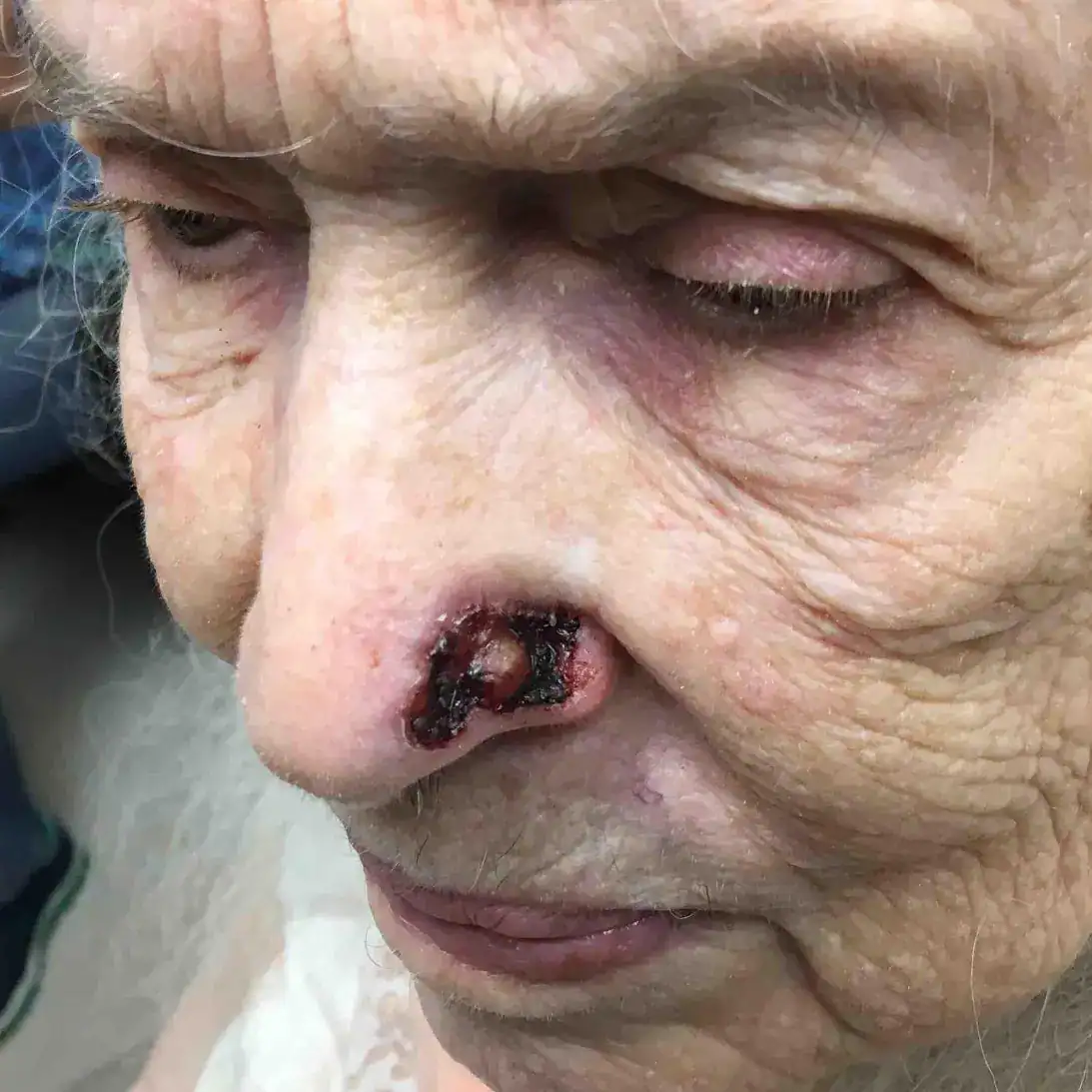 Subject 1, shown before superficial radiotherapy (SRT) at Goodman Dermatology