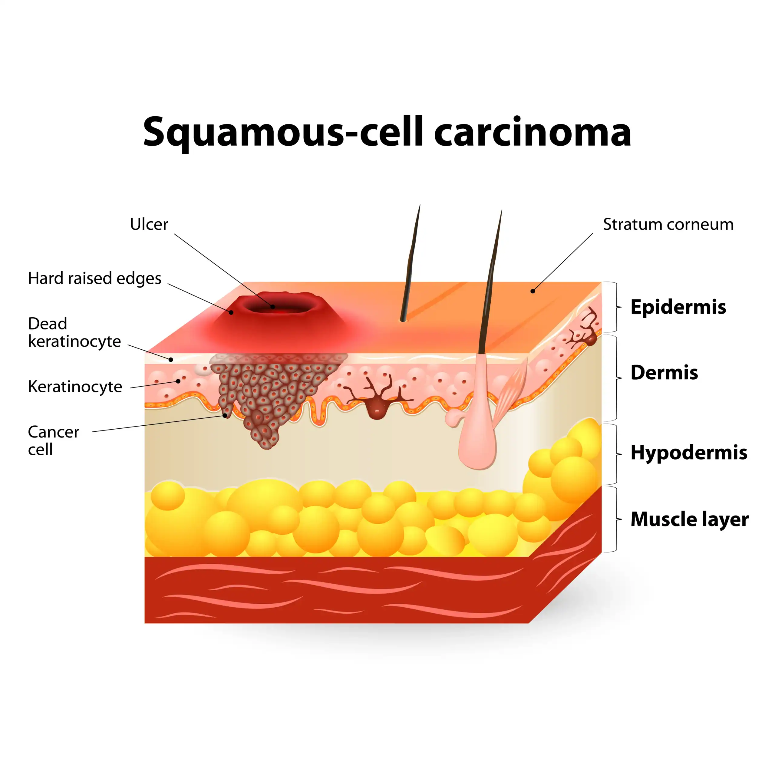Infographic showing how squamous cell carcinoma affects the skin
