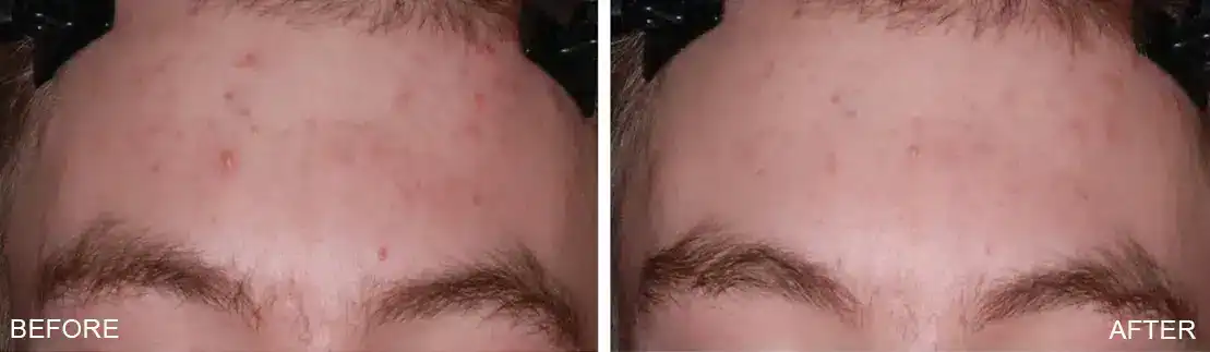 Subject 1 shown before and after 1 treatment of TheraClearX