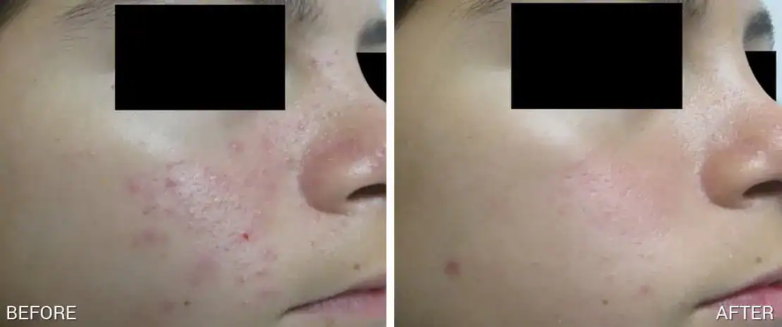 Subject 3 shown before and after one treatment of TheraClearX by Suneel Chilukuri, MD
