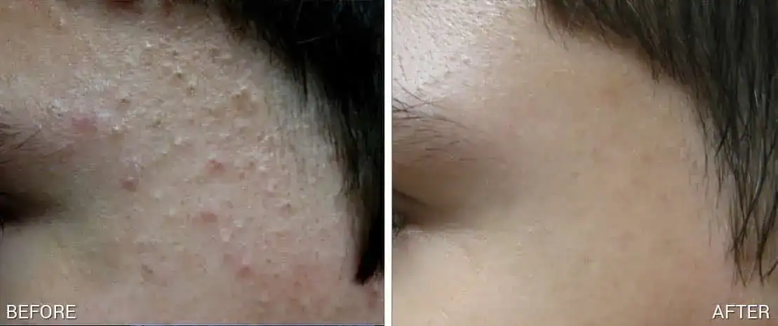 Subject 4 shown before and after 3 treatments of TheraClearX by Suneel Chilukuri, MD
