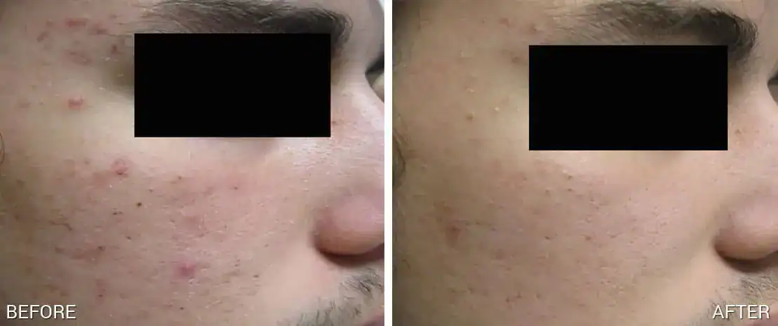 Subject 5 shown before and after 4 treatments of TheraClearX by Suneel Chilukuri, MD