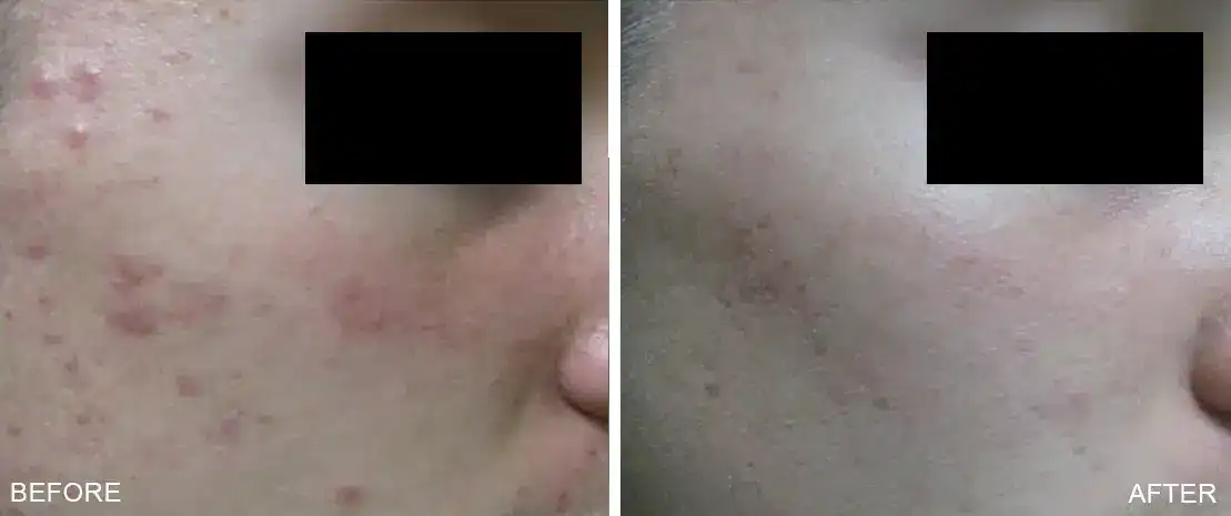 Subject 6 shown before and after 5 treatments of TheraClearX by Suneel Chilukuri, MD