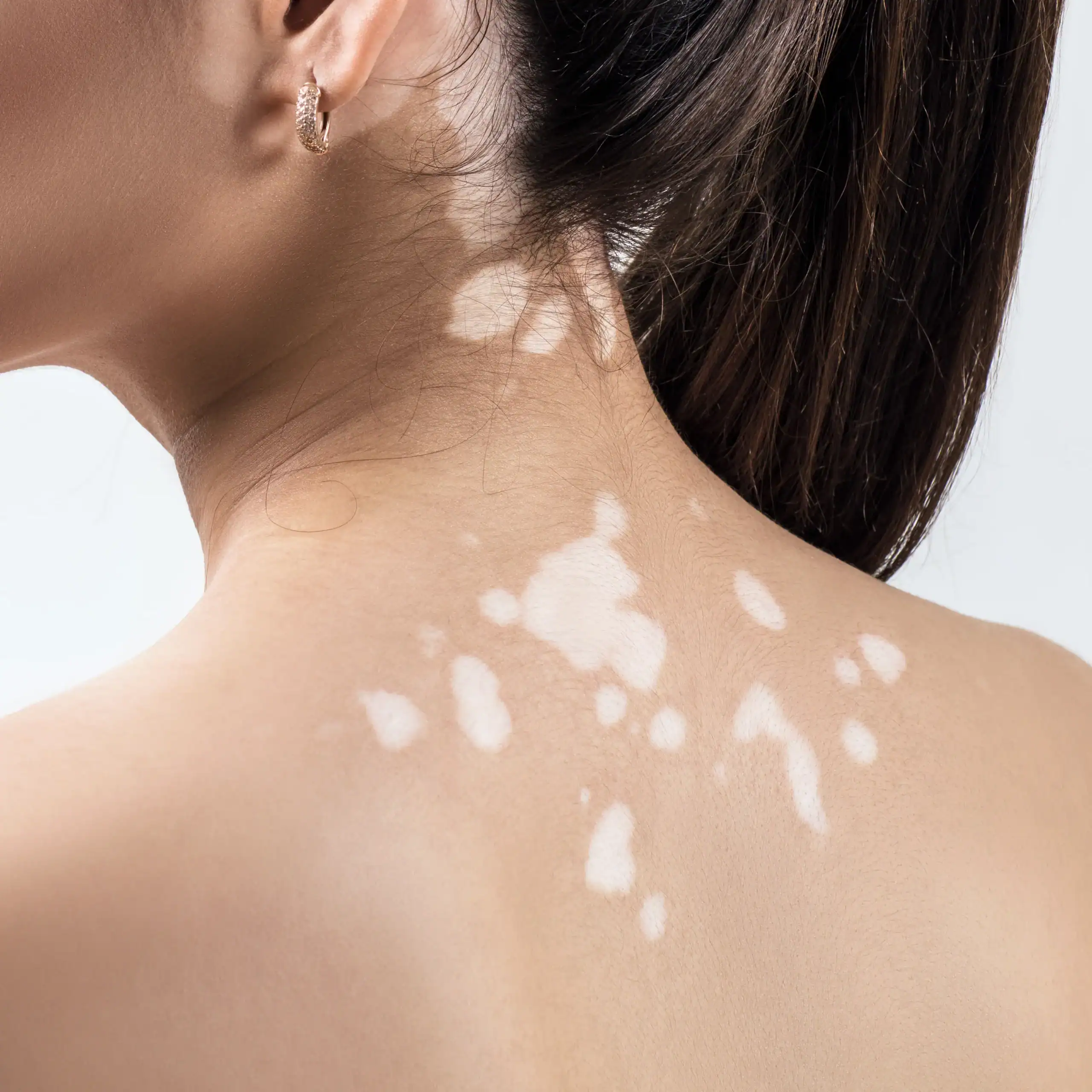 Woman with vitiligo patches of white skin on her back