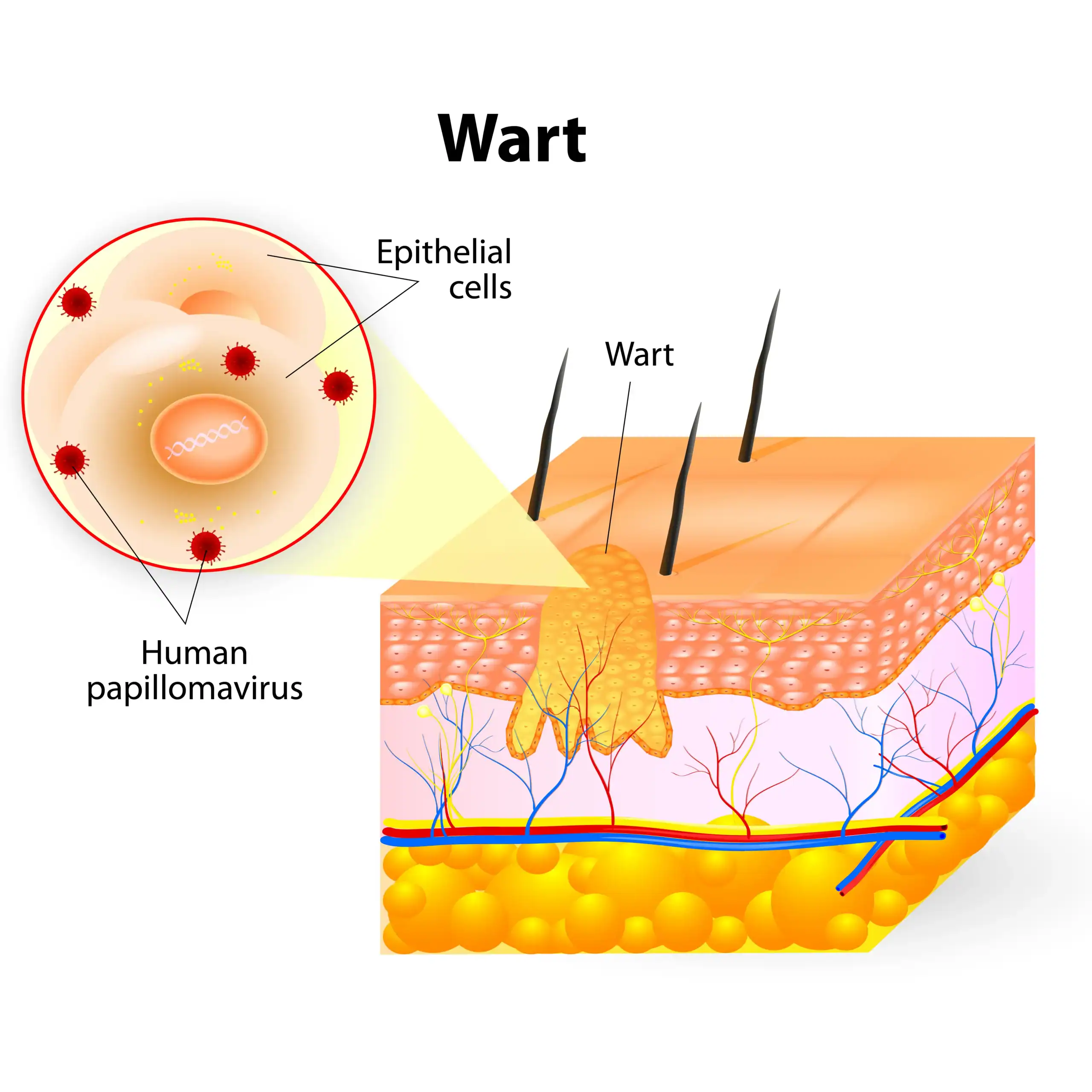 Illustration of how a wart forms in the skin