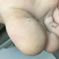Subject 1, shown after wart removal at Goodman Dermatology