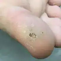 Subject 1, shown before wart removal at Goodman Dermatology