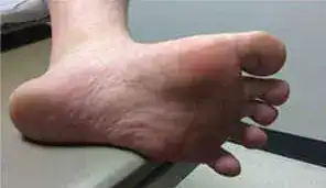 Subject 2, shown after wart removal at Goodman Dermatology
