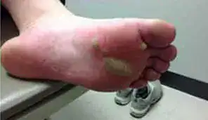 Subject 2, shown before wart removal at Goodman Dermatology